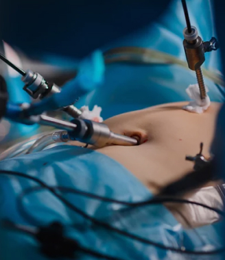 Laparoscopic (Keyhole) Hernia Surgery